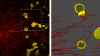 Microscopy images showing that When sensory neurons (red) are cultured with stomach cancer organoids (yellow), the neuron and cancer cells create connections that resemble synapses and establish an electrical circuit among the cells.